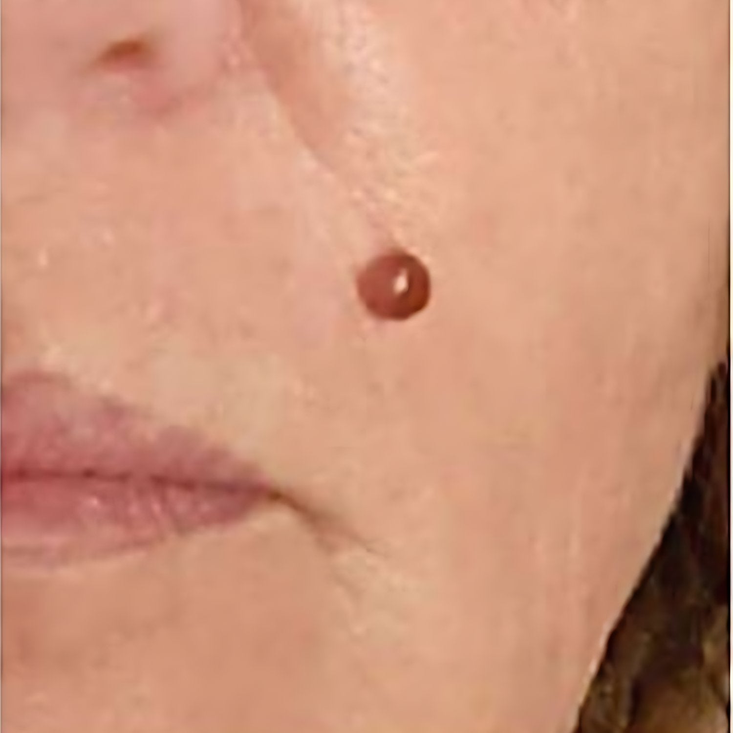 After Photobiomodulation Treatment on Wrinkles A before-and-after comparison showing the impact of photobiomodulation on wrinkles. The left side (Day 0) displays visible wrinkles, while the right side (Day 28) shows reduced wrinkle appearance, demonstrating the effectiveness of the treatment.